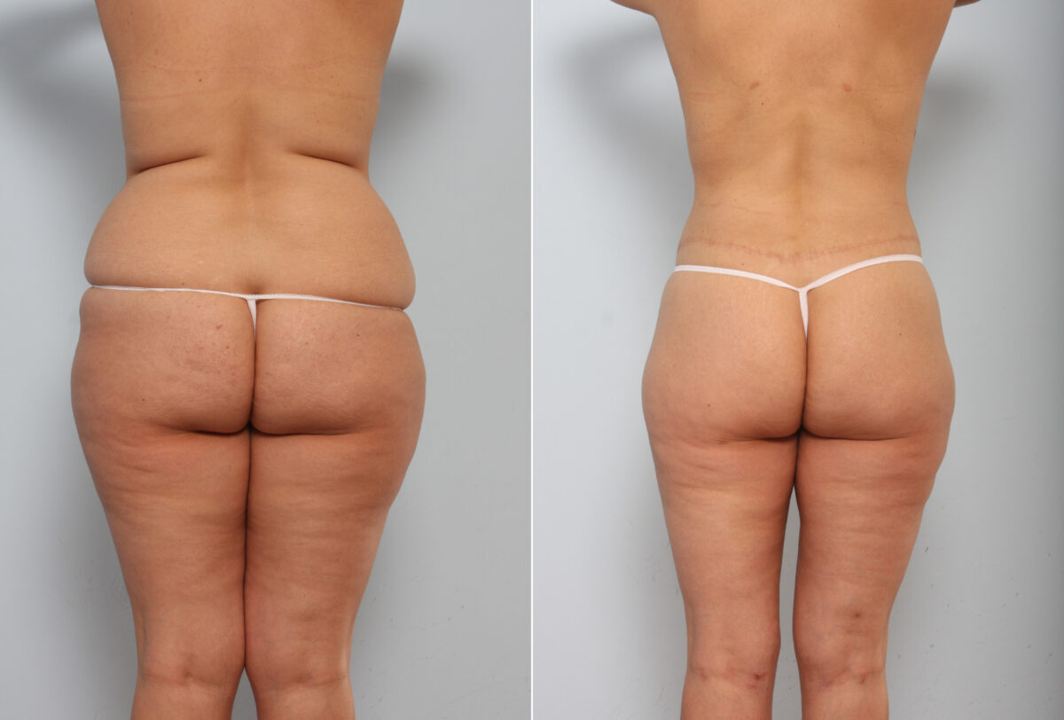 Body Lift before and after photos in Houston, TX, Patient 56918