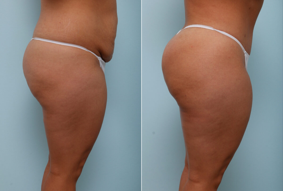 Body Lift before and after photos in Houston, TX, Patient 57020