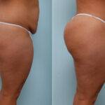 Body Lift before and after photos in Houston, TX, Patient 57020