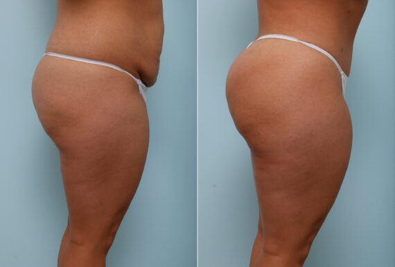 Body Lift before and after photos in Houston, TX, Patient 57020