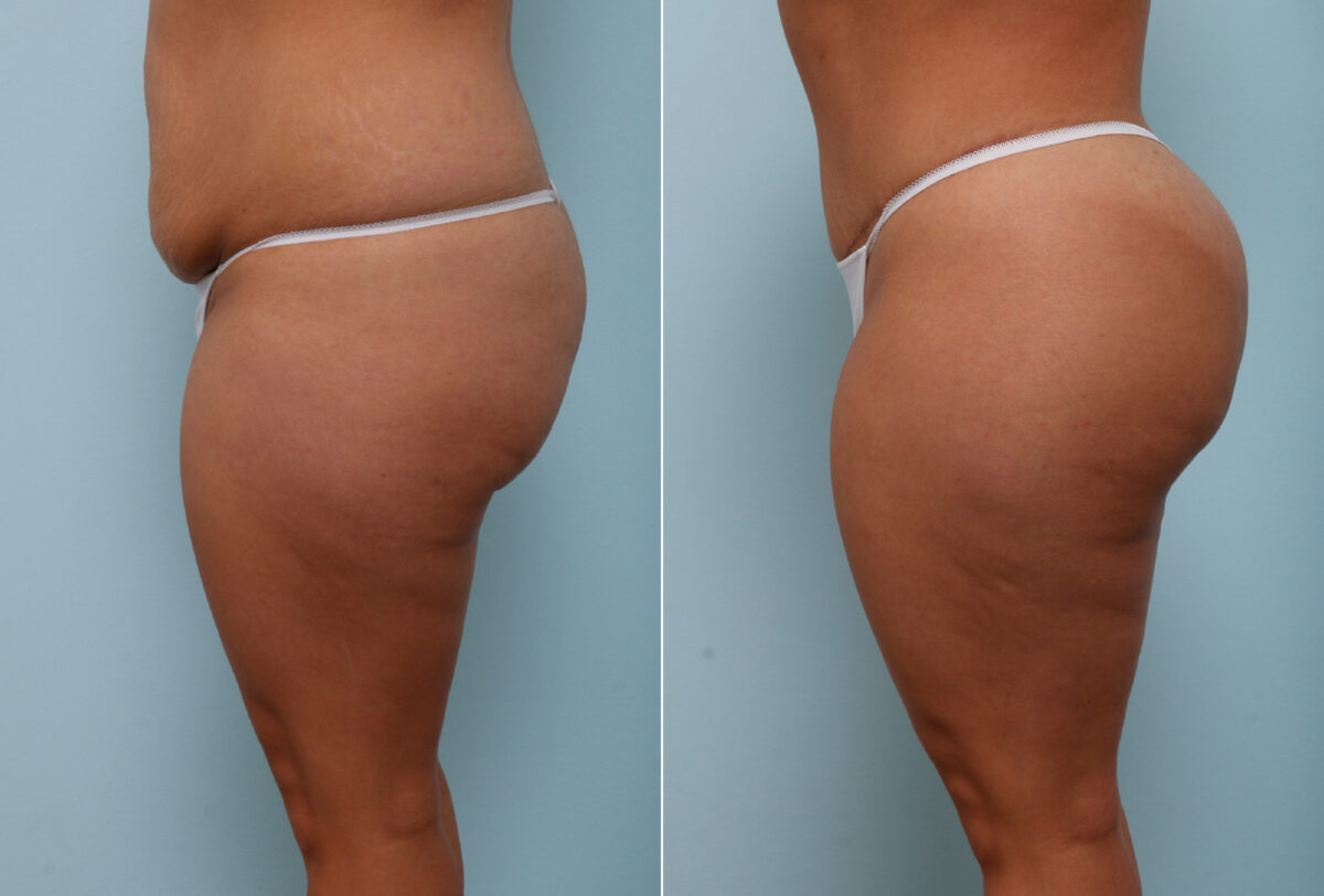 Body Lift before and after photos in Houston, TX, Patient 57020