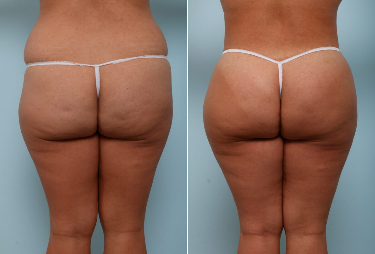 Body Lift before and after photos in Houston, TX, Patient 57020