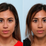 Non-Surgical Rhinoplasty before and after photos in Houston, TX, Patient 57373