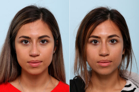 Non-Surgical Rhinoplasty before and after photos in Houston, TX, Patient 57373