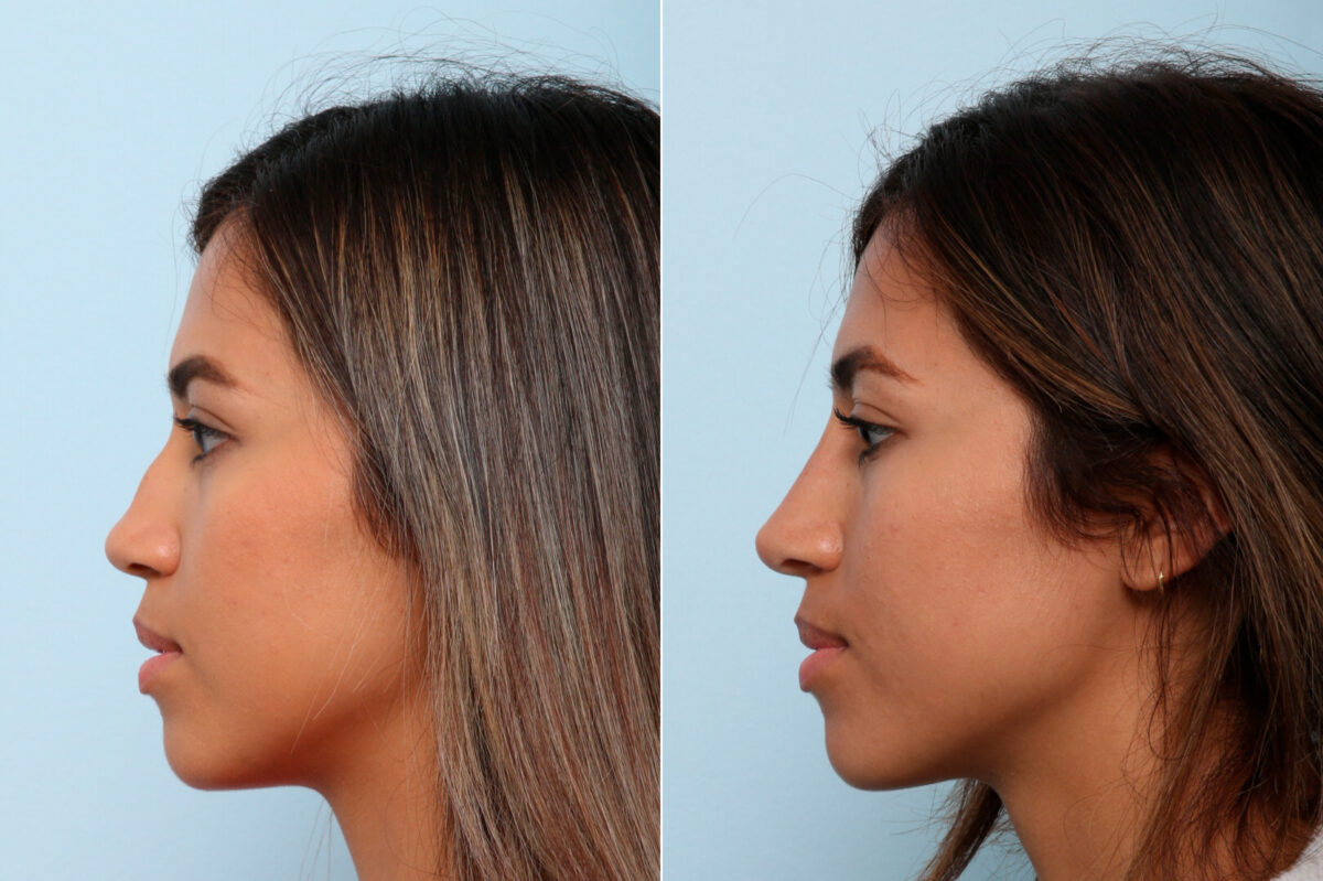 Non-Surgical Rhinoplasty before and after photos in Houston, TX, Patient 57373