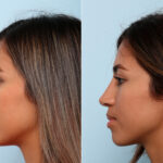 Non-Surgical Rhinoplasty before and after photos in Houston, TX, Patient 57373