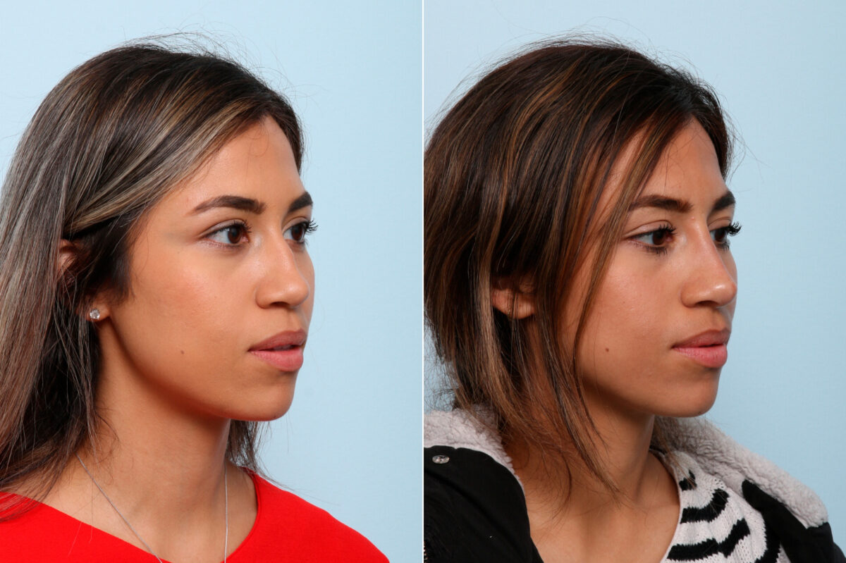 Non-Surgical Rhinoplasty before and after photos in Houston, TX, Patient 57373