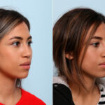 Non-Surgical Rhinoplasty before and after photos in Houston, TX, Patient 57373