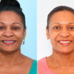 Botox® Cosmetic before and after photos in Houston, TX, Patient 57390