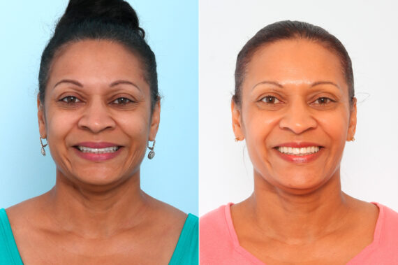 Xeomin / Botox® Cosmetic before and after photos in Houston, TX, Patient 57390