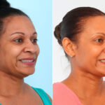 Botox® Cosmetic before and after photos in Houston, TX, Patient 57390