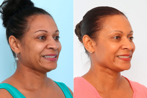 Xeomin / Botox® Cosmetic before and after photos in Houston, TX, Patient 57390