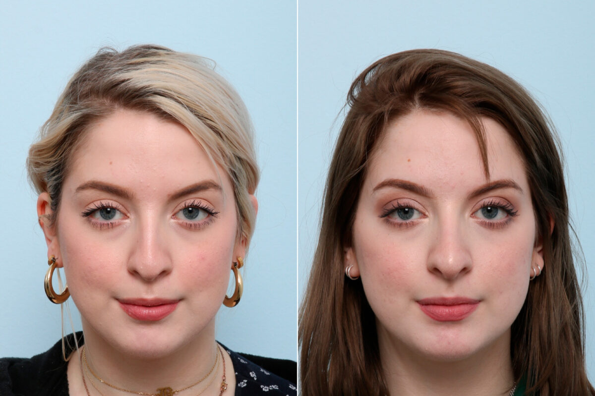 Non-Surgical Rhinoplasty before and after photos in Houston, TX, Patient 57426