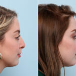 Non-Surgical Rhinoplasty before and after photos in Houston, TX, Patient 57426