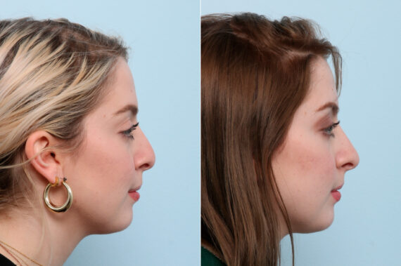 Non-Surgical Rhinoplasty before and after photos in Houston, TX, Patient 57426