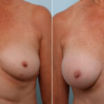 Mommy Makeover before and after photos in Houston, TX, Patient 57567