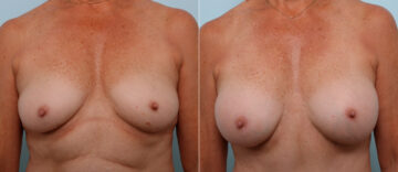 Mommy Makeover before and after photos in Houston, TX, Patient 57567