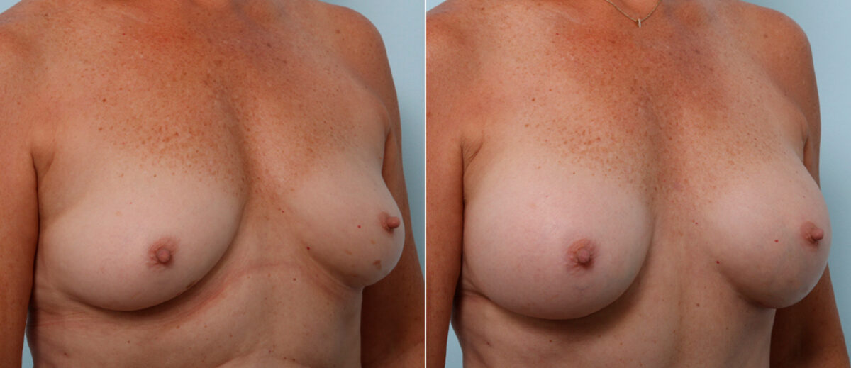Mommy Makeover before and after photos in Houston, TX, Patient 57567