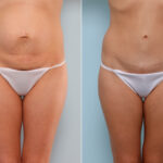 Mommy Makeover before and after photos in Houston, TX, Patient 57553