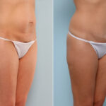 Mommy Makeover before and after photos in Houston, TX, Patient 57553
