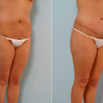 Abdominoplasty before and after photos in Houston, TX, Patient 24261