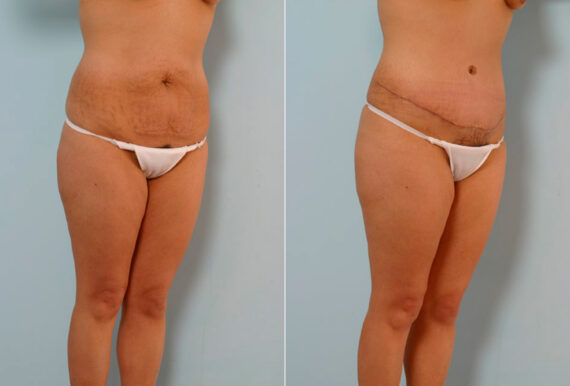 Tummy Tuck/Abdominoplasty before and after photos in Houston, TX, Patient 24261