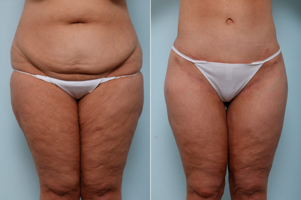 Thigh Lift before and after photos in Houston, TX, Patient 57839