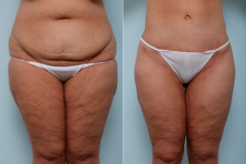 Thigh Lift before and after photos in Houston, TX, Patient 57839