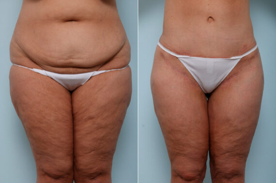 Thigh Lift before and after photos in Houston, TX, Patient 57839