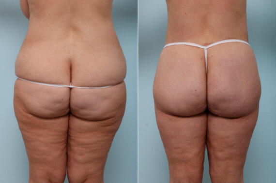 Thigh Lift before and after photos in Houston, TX, Patient 57839