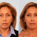 Fat Grafting before and after photos in Houston, TX, Patient 57903