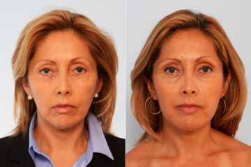 Fat Grafting before and after photos in Houston, TX, Patient 57903