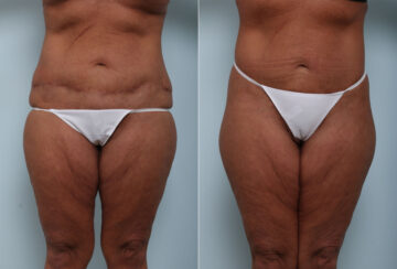 Body Lift before and after photos in Houston, TX, Patient 58622