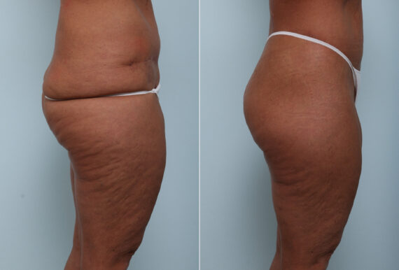 Body Lift before and after photos in Houston, TX, Patient 58622