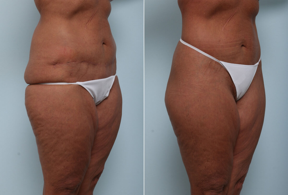 Body Lift before and after photos in Houston, TX, Patient 58622