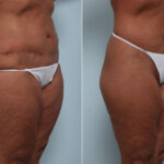 Body Lift before and after photos in Houston, TX, Patient 58622