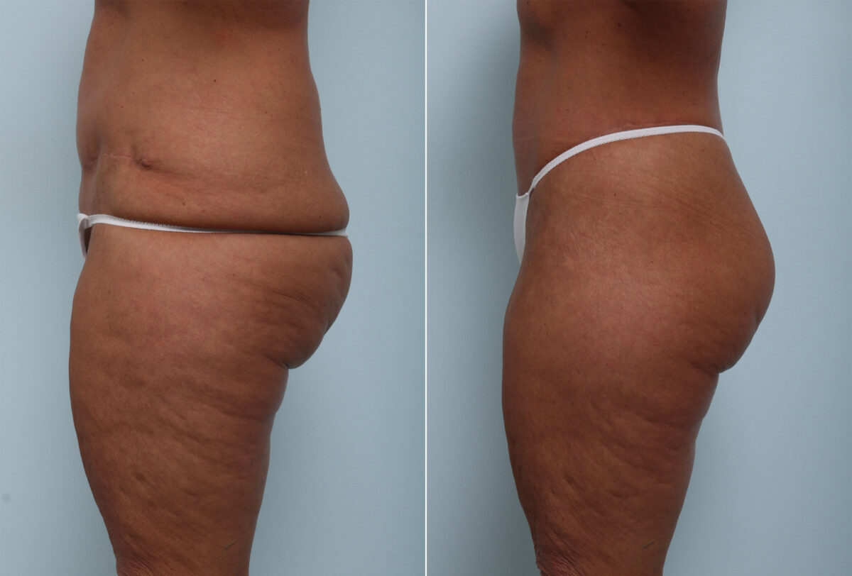 Body Lift before and after photos in Houston, TX, Patient 58622