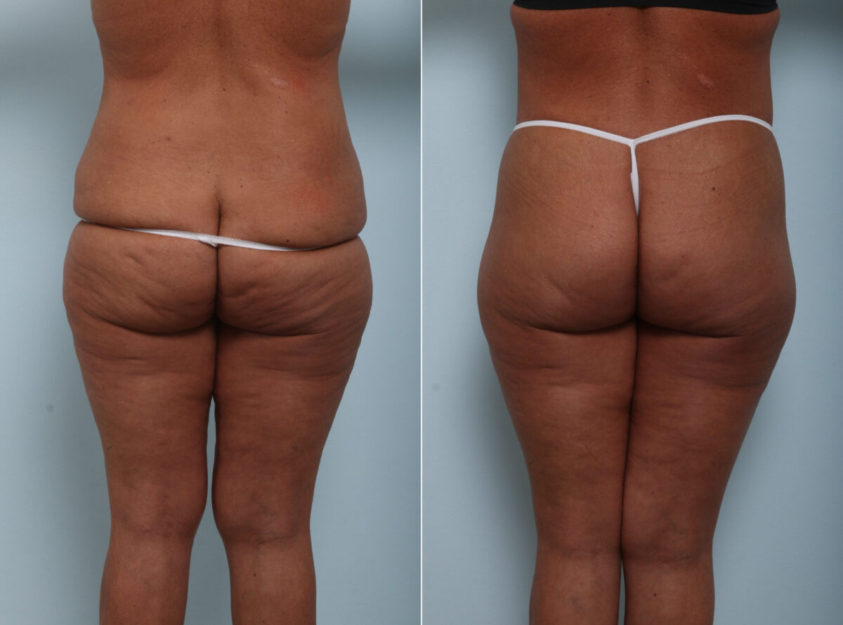 Body Lift before and after photos in Houston, TX, Patient 58622