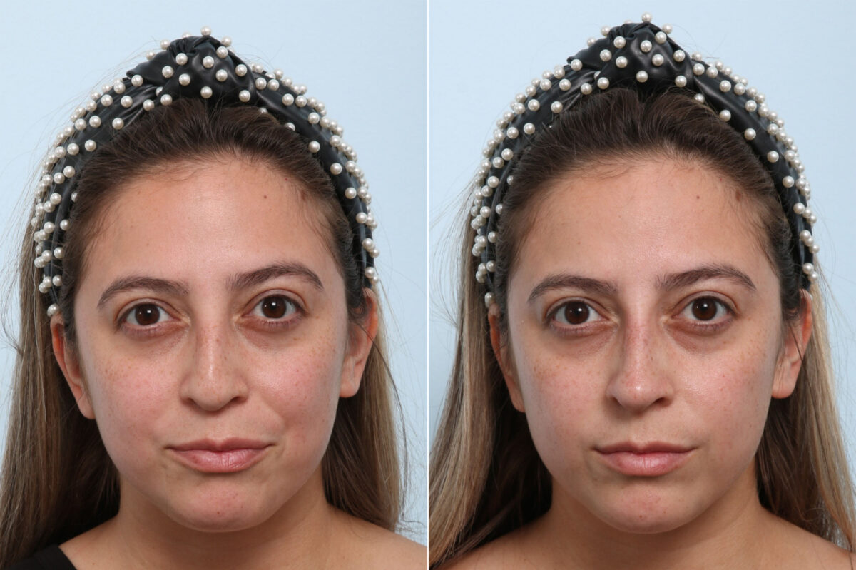 Non-Surgical Rhinoplasty before and after photos in Houston, TX, Patient 58638