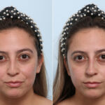 Non-Surgical Rhinoplasty before and after photos in Houston, TX, Patient 58638