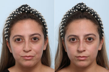 Non-Surgical Rhinoplasty before and after photos in Houston, TX, Patient 58638