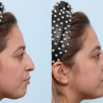 Non-Surgical Rhinoplasty before and after photos in Houston, TX, Patient 58638