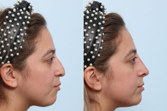 Non-Surgical Rhinoplasty before and after photos in Houston, TX, Patient 58638