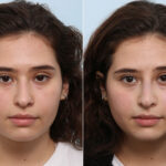 Non-Surgical Rhinoplasty before and after photos in Houston, TX, Patient 58648