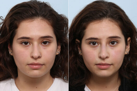 Non-Surgical Rhinoplasty before and after photos in Houston, TX, Patient 58648