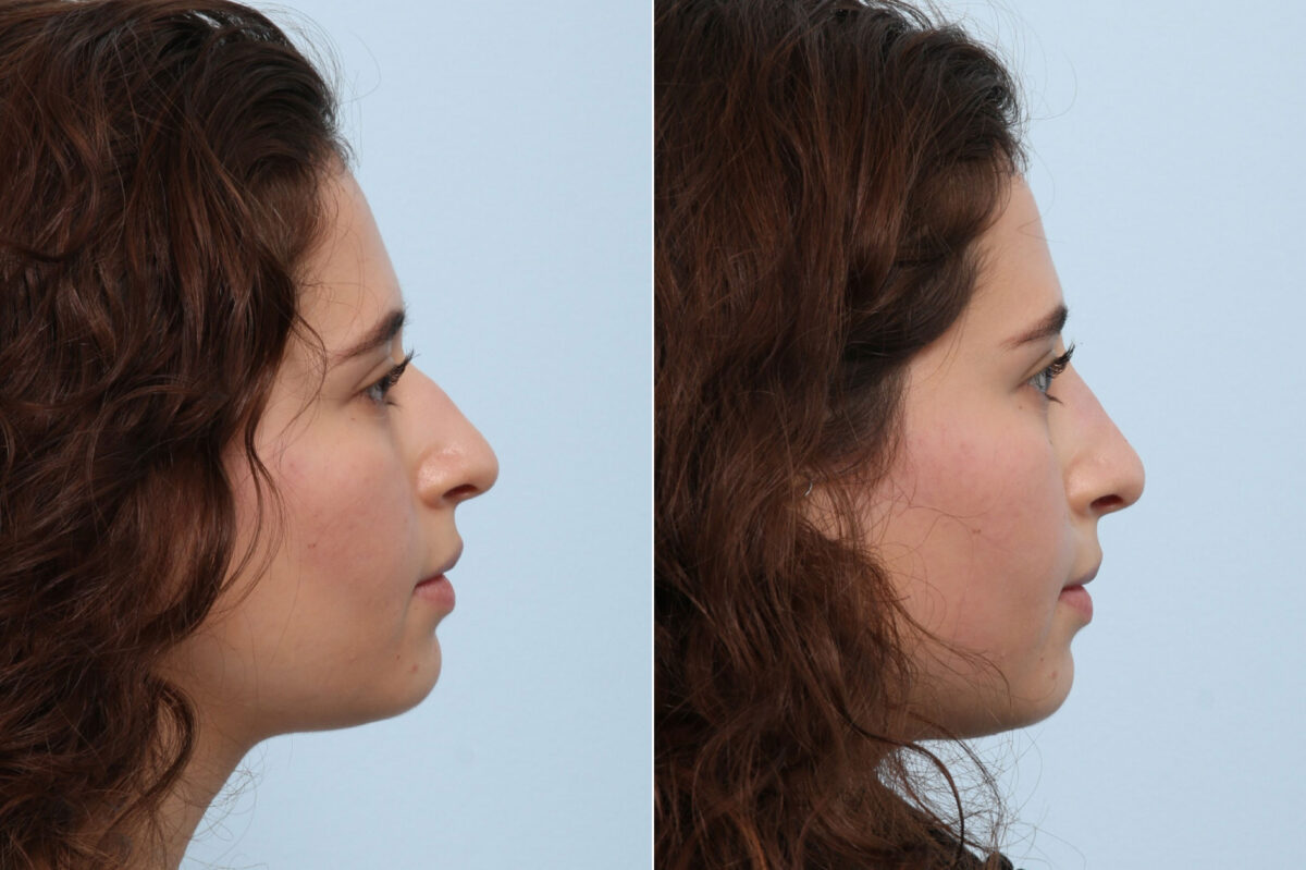 Non-Surgical Rhinoplasty before and after photos in Houston, TX, Patient 58648