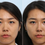 Non-Surgical Rhinoplasty before and after photos in Houston, TX, Patient 58662
