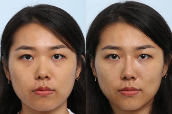 Non-Surgical Rhinoplasty before and after photos in Houston, TX, Patient 58662