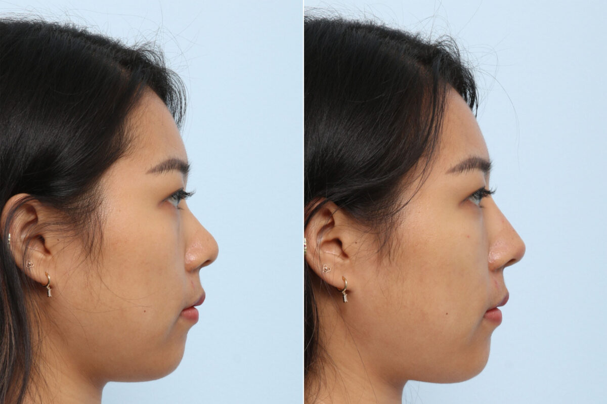 Non-Surgical Rhinoplasty before and after photos in Houston, TX, Patient 58662