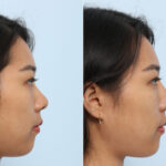 Non-Surgical Rhinoplasty before and after photos in Houston, TX, Patient 58662